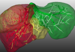 Bild des Projekts Optimale Tumorbehandlung in der Leber durch Optimierung mit partiellen Differentialgleichungen