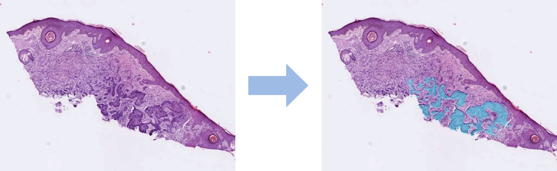 Automatic Tumor Detection